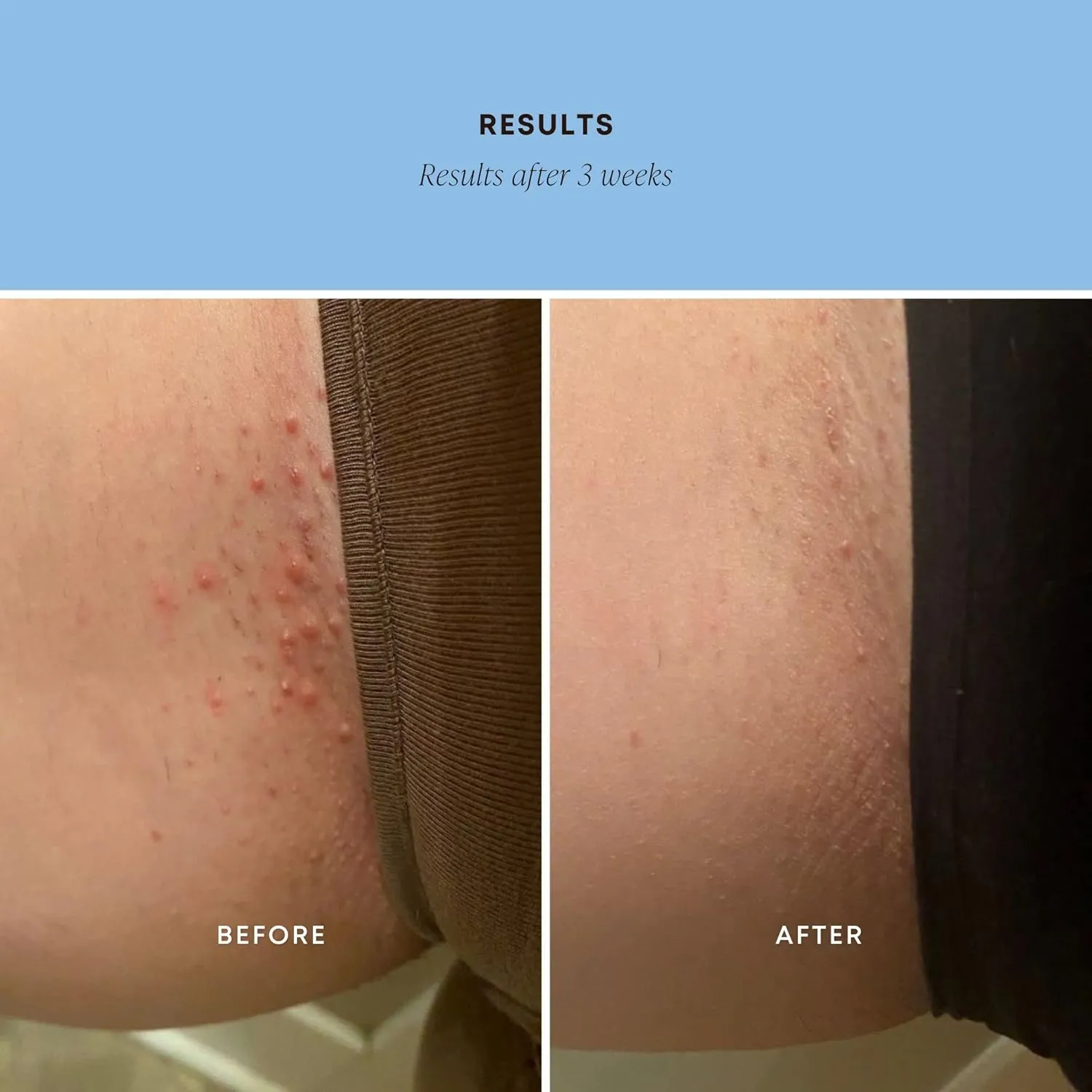 Bushbalm Ingrown Hair Exfoliating Scrub - Reduces Appearance of Ingrown Hairs and Underarm Bumps, Soothes Skin and Post Shave Redness - Nude, 236 ml
